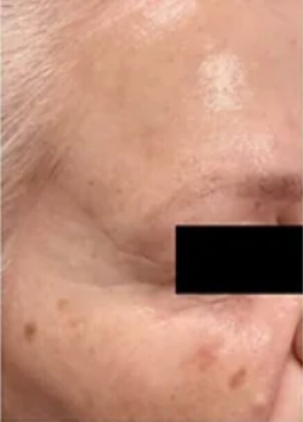 After microneedling: the same area with smoother skin and softer lines. Eye area redacted.