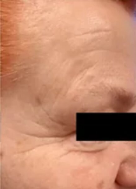 Before microneedling: creased skin with fine lines beside the eye and across the temple. Eye area redacted.