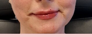 Lip filler — after