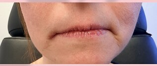 Lip filler — before