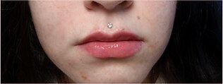 Lip filler — after