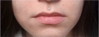 Lip filler — before