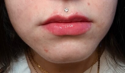 Lip filler — after