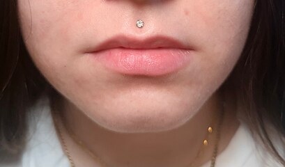 Lip filler — before