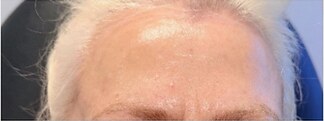 Microneedling — after
