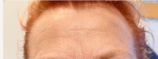 Microneedling — before