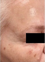 Microneedling — after