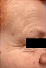 Microneedling — before