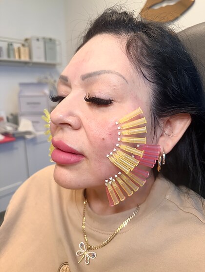 Collagen PDO threads being placed on the cheek.