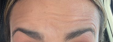 Wrinkle relaxers — after