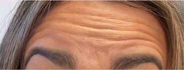 Wrinkle relaxers — before