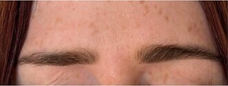 Wrinkle relaxers — after