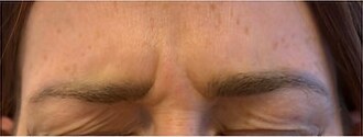 Wrinkle relaxers — before